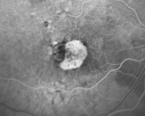 Small Retinal Pigment Epithelial Rip and Poor Vision (20/400)
80-year-old woman vision in the right eye has substantially declined.  
  OD:  20/400;  OS:  20/50
