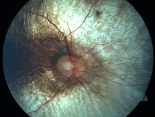 26-year-old man choroideremia OU is 20/60
