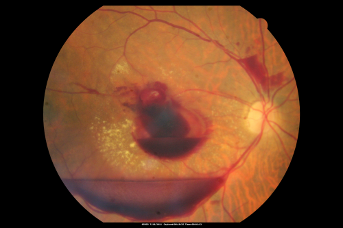Retinal Arterial Macroaneurysm - Recurrent Hemorrhage 6 months post laser
6 months post laser: Her vision had improved, but then three weeks ago it worsened again.  She is not on any blood thinners.  She wasnâ€™t doing any heavy lifting or straining.  

VISUAL ACUITY:  OD 3/200
