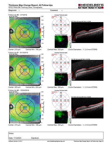 BRVO with late onset venous macroaneurysm
The vision improved on presentation from 20/160 - 20/32 with Avastin,  Then a few years later, he developed a venous Macroaneurysm which was lasered .  Avastin shots were then stopped.
