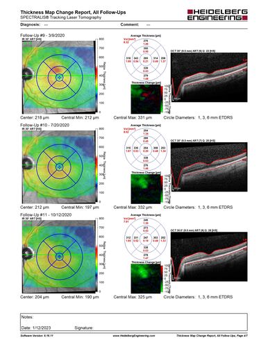 BRVO with late onset venous macroaneurysm
The vision improved on presentation from 20/160 - 20/32 with Avastin,  Then a few years later, he developed a venous Macroaneurysm which was lasered .  Avastin shots were then stopped.
