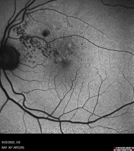 BRVO with late onset venous macroaneurysm
The vision improved on presentation from 20/160 - 20/32 with Avastin,  Then a few years later, he developed a venous Macroaneurysm which was lasered .  Avastin shots were then stopped.
