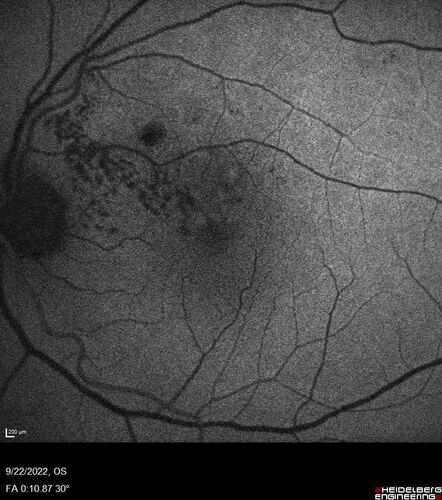 BRVO with late onset venous macroaneurysm
The vision improved on presentation from 20/160 - 20/32 with Avastin,  Then a few years later, he developed a venous Macroaneurysm which was lasered .  Avastin shots were then stopped.
