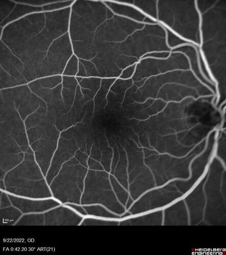 BRVO with late onset venous macroaneurysm
The vision improved on presentation from 20/160 - 20/32 with Avastin,  Then a few years later, he developed a venous Macroaneurysm which was lasered .  Avastin shots were then stopped.
