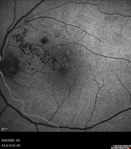 BRVO with late onset venous macroaneurysm
The vision improved on presentation from 20/160 - 20/32 with Avastin,  Then a few years later, he developed a venous Macroaneurysm which was lasered .  Avastin shots were then stopped.
