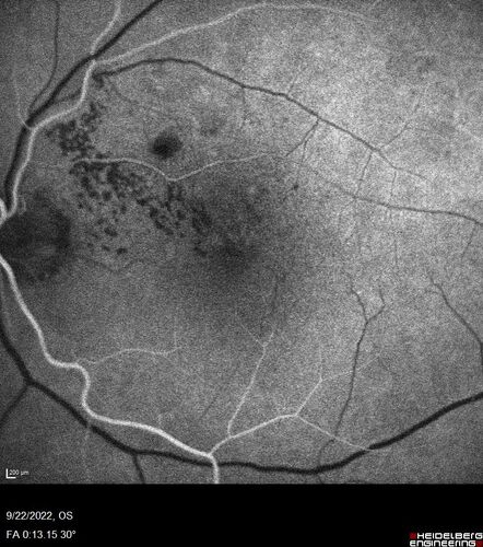 BRVO with late onset venous macroaneurysm
The vision improved on presentation from 20/160 - 20/32 with Avastin,  Then a few years later, he developed a venous Macroaneurysm which was lasered .  Avastin shots were then stopped.
