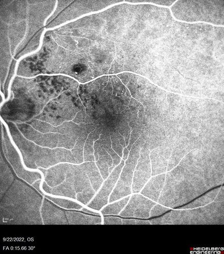 BRVO with late onset venous macroaneurysm
The vision improved on presentation from 20/160 - 20/32 with Avastin,  Then a few years later, he developed a venous Macroaneurysm which was lasered .  Avastin shots were then stopped.
