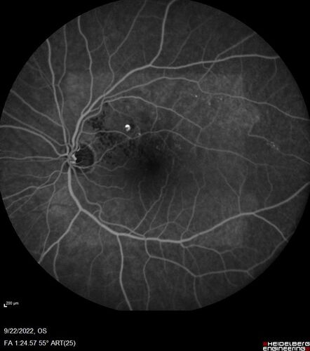BRVO with late onset venous macroaneurysm
The vision improved on presentation from 20/160 - 20/32 with Avastin,  Then a few years later, he developed a venous Macroaneurysm which was lasered .  Avastin shots were then stopped.
