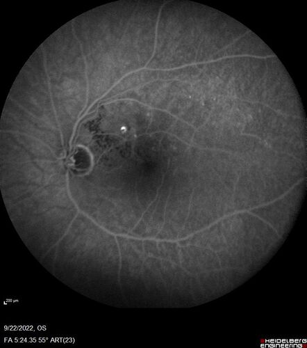 BRVO with late onset venous macroaneurysm
The vision improved on presentation from 20/160 - 20/32 with Avastin,  Then a few years later, he developed a venous Macroaneurysm which was lasered .  Avastin shots were then stopped.
