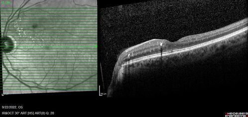 BRVO with late onset venous macroaneurysm
The vision improved on presentation from 20/160 - 20/32 with Avastin,  Then a few years later, he developed a venous Macroaneurysm which was lasered .  Avastin shots were then stopped.
