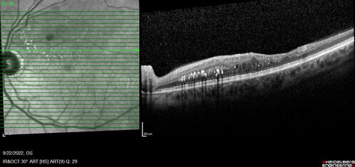 BRVO with late onset venous macroaneurysm
The vision improved on presentation from 20/160 - 20/32 with Avastin,  Then a few years later, he developed a venous Macroaneurysm which was lasered .  Avastin shots were then stopped.
