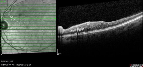 BRVO with late onset venous macroaneurysm
The vision improved on presentation from 20/160 - 20/32 with Avastin,  Then a few years later, he developed a venous Macroaneurysm which was lasered .  Avastin shots were then stopped.
