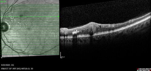 BRVO with late onset venous macroaneurysm
The vision improved on presentation from 20/160 - 20/32 with Avastin,  Then a few years later, he developed a venous Macroaneurysm which was lasered .  Avastin shots were then stopped.
