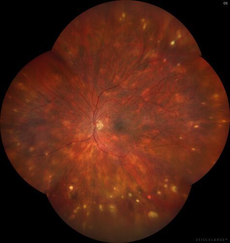 Sarcoid Multifocal Choroiditis 2020- Color Montage
68 year old man with biopsy proven (by dentist) sarcoidosis.  Problems with recurrent vitreous cells responsive to PST kenalog injections.  VA 20/32 OU
