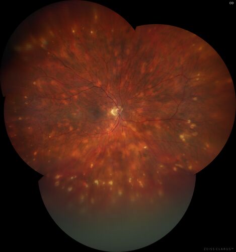 Sarcoid Multifocal Choroiditis 2020- Color Montage
68 year old man with biopsy proven (by dentist) sarcoidosis.  Problems with recurrent vitreous cells responsive to PST kenalog injections.  VA 20/32 OU
