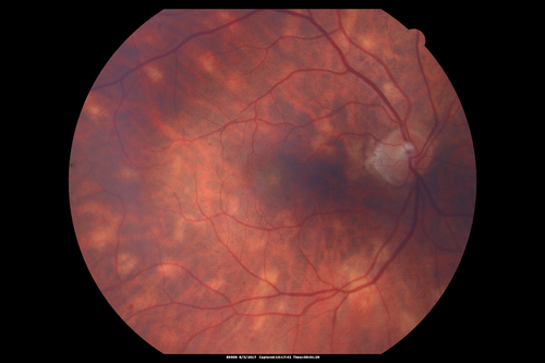 Sarcoidosis Multifocal Choroiditis
66 year old man with dense cataracts and recurrent uveitis.  Images show multifocal choroidal granulomas from sarcoidosis more in the right eye than the left eye.
