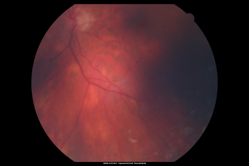 Sarcoidosis Multifocal Choroiditis
66 year old man with dense cataracts and recurrent uveitis.  Images show multifocal choroidal granulomas from sarcoidosis more in the right eye than the left eye.
