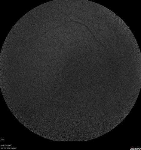 Sarcoidosis Multifocal Choroiditis
66 year old man with dense cataracts and recurrent uveitis.  Images show multifocal choroidal granulomas from sarcoidosis more in the right eye than the left eye.
