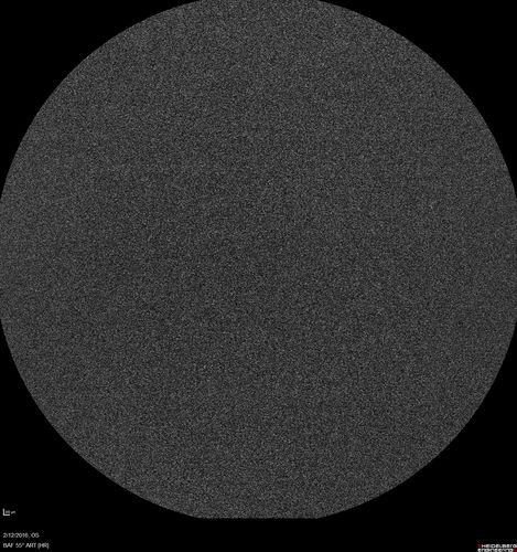 Sarcoidosis Multifocal Choroiditis
66 year old man with dense cataracts and recurrent uveitis.  Images show multifocal choroidal granulomas from sarcoidosis more in the right eye than the left eye.

