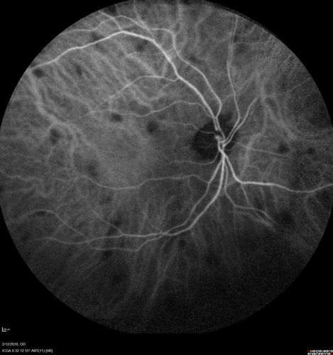 Sarcoidosis Multifocal Choroiditis
66 year old man with dense cataracts and recurrent uveitis.  Images show multifocal choroidal granulomas from sarcoidosis more in the right eye than the left eye.
