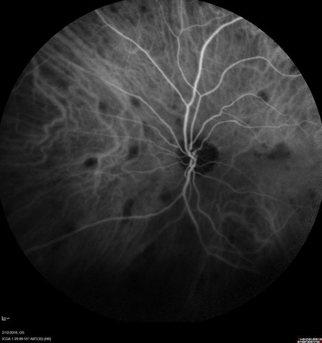 Sarcoidosis Multifocal Choroiditis
66 year old man with dense cataracts and recurrent uveitis.  Images show multifocal choroidal granulomas from sarcoidosis more in the right eye than the left eye.
