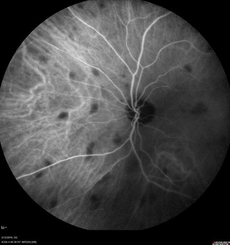Sarcoidosis Multifocal Choroiditis
66 year old man with dense cataracts and recurrent uveitis.  Images show multifocal choroidal granulomas from sarcoidosis more in the right eye than the left eye.
