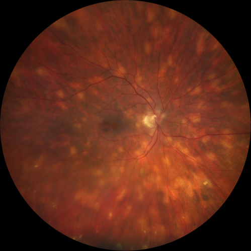 Sarcoid Multifocal Choroiditis - Posterior Uveitis
66 year old man with biopsy proven (by dentist) sarcoidosis.  Problems with recurrent vitreous cells responsive to PST kenalog injections.  VA 20/32 OU
