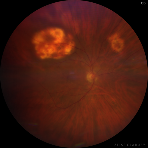 Sclerochoroidal Calcification - Large Lesion
77 year old white male retired physician.  The patient was noticing a change in vision and saw you for a checkup.Â  He used to see better from a distance without glasses and now he takes his glasses off to read.Â  There is a mass in the right eye.Â Â 
VA OD: Dcc20/50-1 PH20/40-1 NccJ1
VA OS: Dcc20/32+1 NccJ1-1
IOP: TP: OD:14 OS:15
