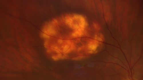 Sclerochoroidal Calcification - Large Lesion
77 year old white male retired physician.  The patient was noticing a change in vision and saw you for a checkup.Â  He used to see better from a distance without glasses and now he takes his glasses off to read.Â  There is a mass in the right eye.Â Â 
VA OD: Dcc20/50-1 PH20/40-1 NccJ1
VA OS: Dcc20/32+1 NccJ1-1
IOP: TP: OD:14 OS:15
