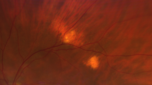 Sclerochoroidal Calcification - Large Lesion
77 year old white male retired physician.  The patient was noticing a change in vision and saw you for a checkup.Â  He used to see better from a distance without glasses and now he takes his glasses off to read.Â  There is a mass in the right eye.Â Â 
VA OD: Dcc20/50-1 PH20/40-1 NccJ1
VA OS: Dcc20/32+1 NccJ1-1
IOP: TP: OD:14 OS:15
