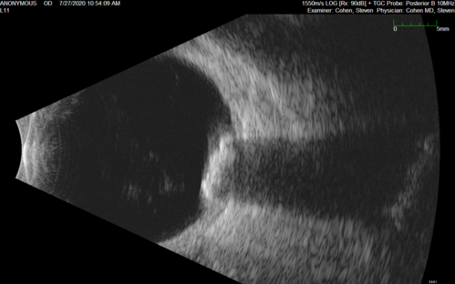 Sclerochoroidal Calcification - Large Lesion
77 year old white male retired physician.  The patient was noticing a change in vision and saw you for a checkup.Â  He used to see better from a distance without glasses and now he takes his glasses off to read.Â  There is a mass in the right eye.Â Â 
VA OD: Dcc20/50-1 PH20/40-1 NccJ1
VA OS: Dcc20/32+1 NccJ1-1
IOP: TP: OD:14 OS:15
