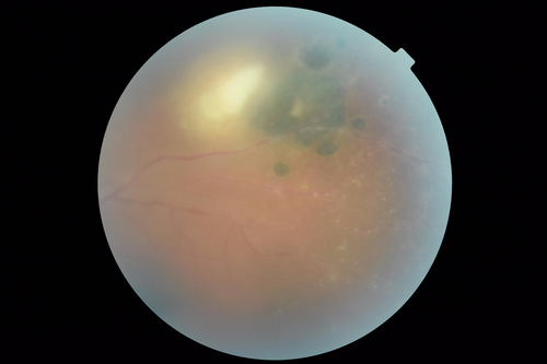 Toxoplasmosis - Recurrent - Moderate Vitritis
32 year old woman with 20/80 vision and moderately painful red eye in the left eye only.  The left eye had some redness about 10 years ago.  She is a native of Sierra Leone
