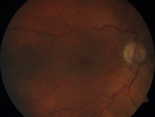 Pigmented Paravenous Retinochoroidal Atrophy - Left Eye
70 year old woman lost vision OS 20 years ago.
