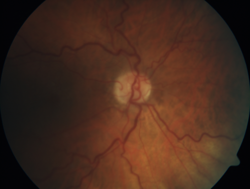 Pigmented Paravenous Retinochoroidal Atrophy - Left Eye
70 year old woman lost vision OS 20 years ago.
