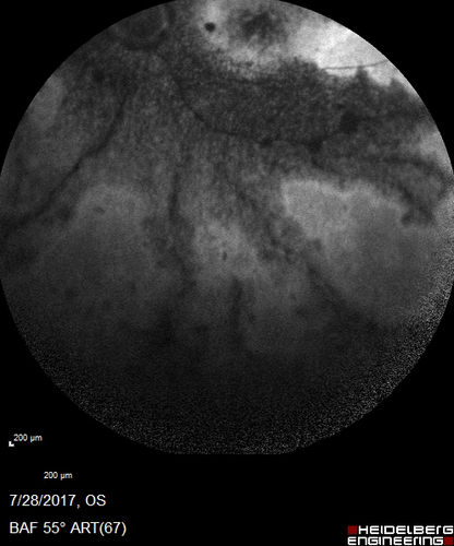 Pigmented Paravenous Retinochoroidal Atrophy - Left Eye
70 year old woman lost vision OS 20 years ago.
