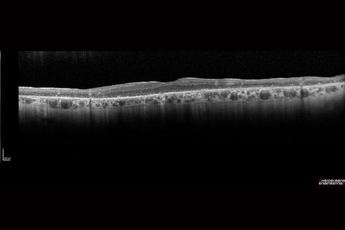 Pigmented Paravenous Retinochoroidal Atrophy - Left Eye
70 year old woman lost vision OS 20 years ago.
