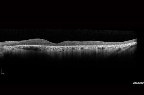 Pigmented Paravenous Retinochoroidal Atrophy - Left Eye
70 year old woman lost vision OS 20 years ago.
