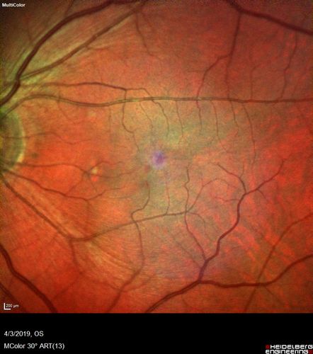 Stellate Non-heredtiary Idiopathic Foveomacular Retinoschisis (SNIFR)
77 year old man who is healthy and 6'6