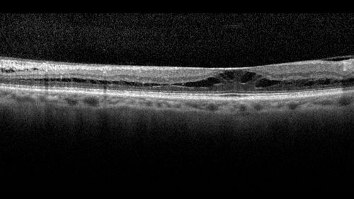 Stellate Non-heredtiary Idiopathic Foveomacular Retinoschisis (SNIFR)
77 year old man who is healthy and 6'6