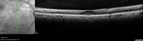 Stellate Non-heredtiary Idiopathic Foveomacular Retinoschisis (SNIFR)
77 year old man who is healthy and 6'6