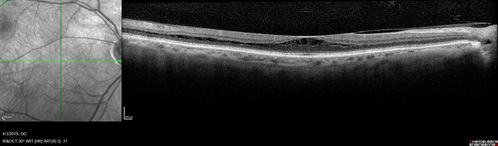 Stellate Non-heredtiary Idiopathic Foveomacular Retinoschisis (SNIFR)
77 year old man who is healthy and 6'6