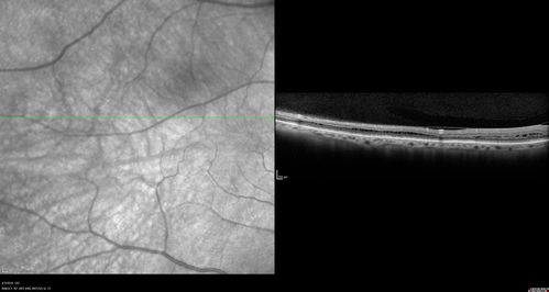 Stellate Non-heredtiary Idiopathic Foveomacular Retinoschisis (SNIFR)
77 year old man who is healthy and 6'6