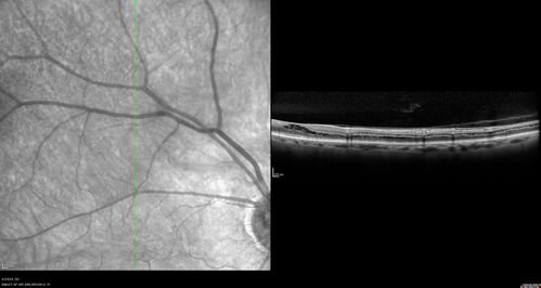 Stellate Non-heredtiary Idiopathic Foveomacular Retinoschisis (SNIFR)
77 year old man who is healthy and 6'6
