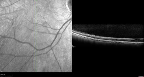 Stellate Non-heredtiary Idiopathic Foveomacular Retinoschisis (SNIFR)
77 year old man who is healthy and 6'6