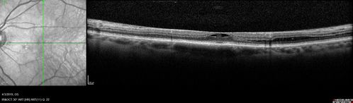 Stellate Non-heredtiary Idiopathic Foveomacular Retinoschisis (SNIFR)
77 year old man who is healthy and 6'6