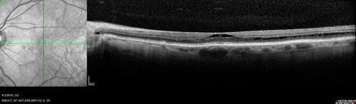 Stellate Non-heredtiary Idiopathic Foveomacular Retinoschisis (SNIFR)
77 year old man who is healthy and 6'6