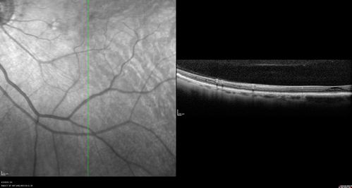Stellate Non-heredtiary Idiopathic Foveomacular Retinoschisis (SNIFR)
77 year old man who is healthy and 6'6