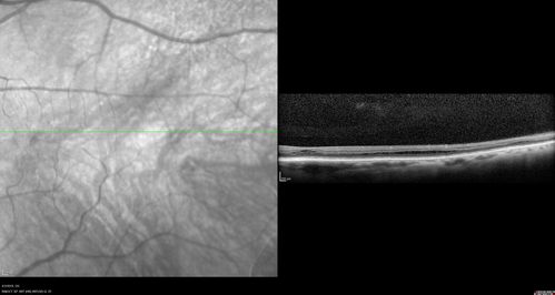Stellate Non-heredtiary Idiopathic Foveomacular Retinoschisis (SNIFR)
77 year old man who is healthy and 6'6