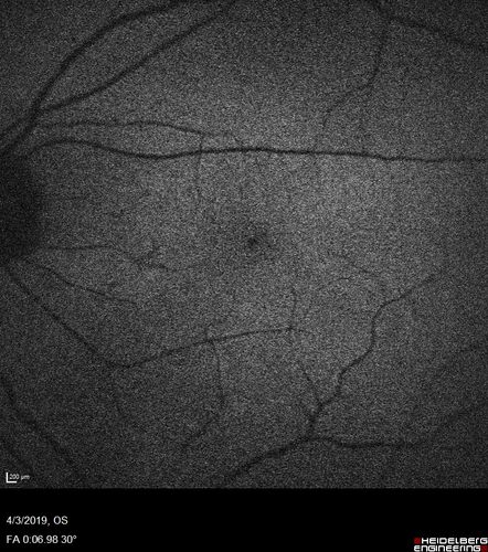 Stellate Non-heredtiary Idiopathic Foveomacular Retinoschisis (SNIFR)
77 year old man who is healthy and 6'6