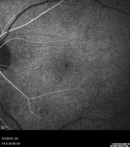 Stellate Non-heredtiary Idiopathic Foveomacular Retinoschisis (SNIFR)
77 year old man who is healthy and 6'6
